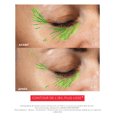 EYE C+ Soin regard Anti-âge Avant/Après Rides Laboratoire ENEOMEY